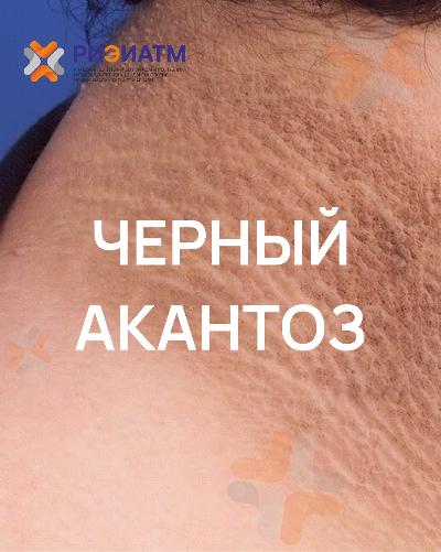 Бўйингиз, қўлтиқ ости ёки бўйин атрофи қорайиб, терингиз қалинлашиб, ғадир-будур тусга кираяптими?